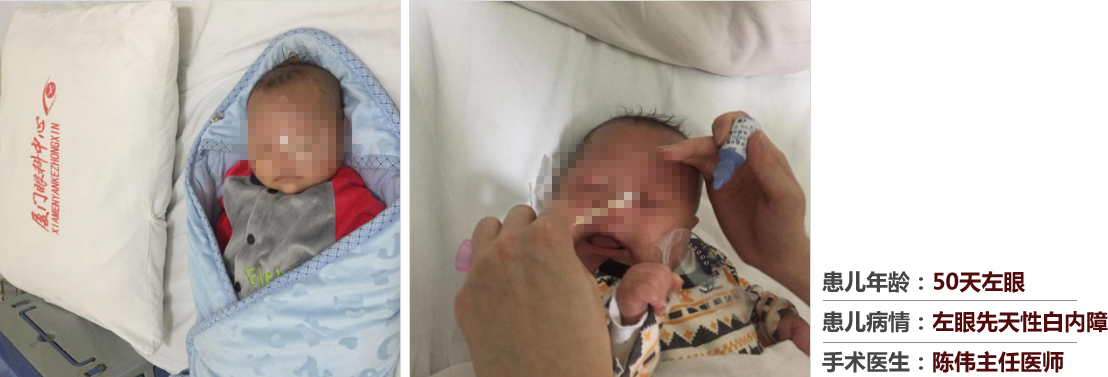 患兒年齡：50天左眼，患兒病情：左眼先天性白內障，手術醫(yī)生：白內障科陳偉主任醫(yī)師