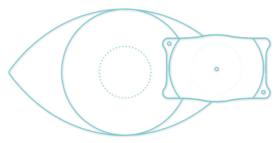 ICL晶體植入術(shù)費用