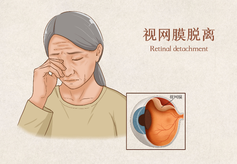 視網膜脫落手術費用
