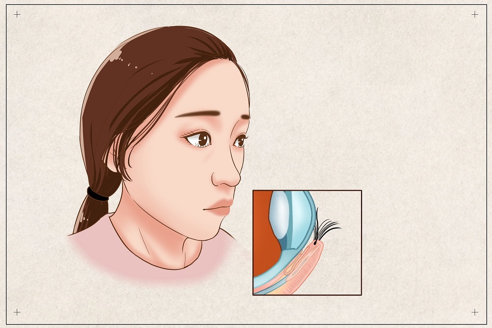 倒睫會自己好嗎？